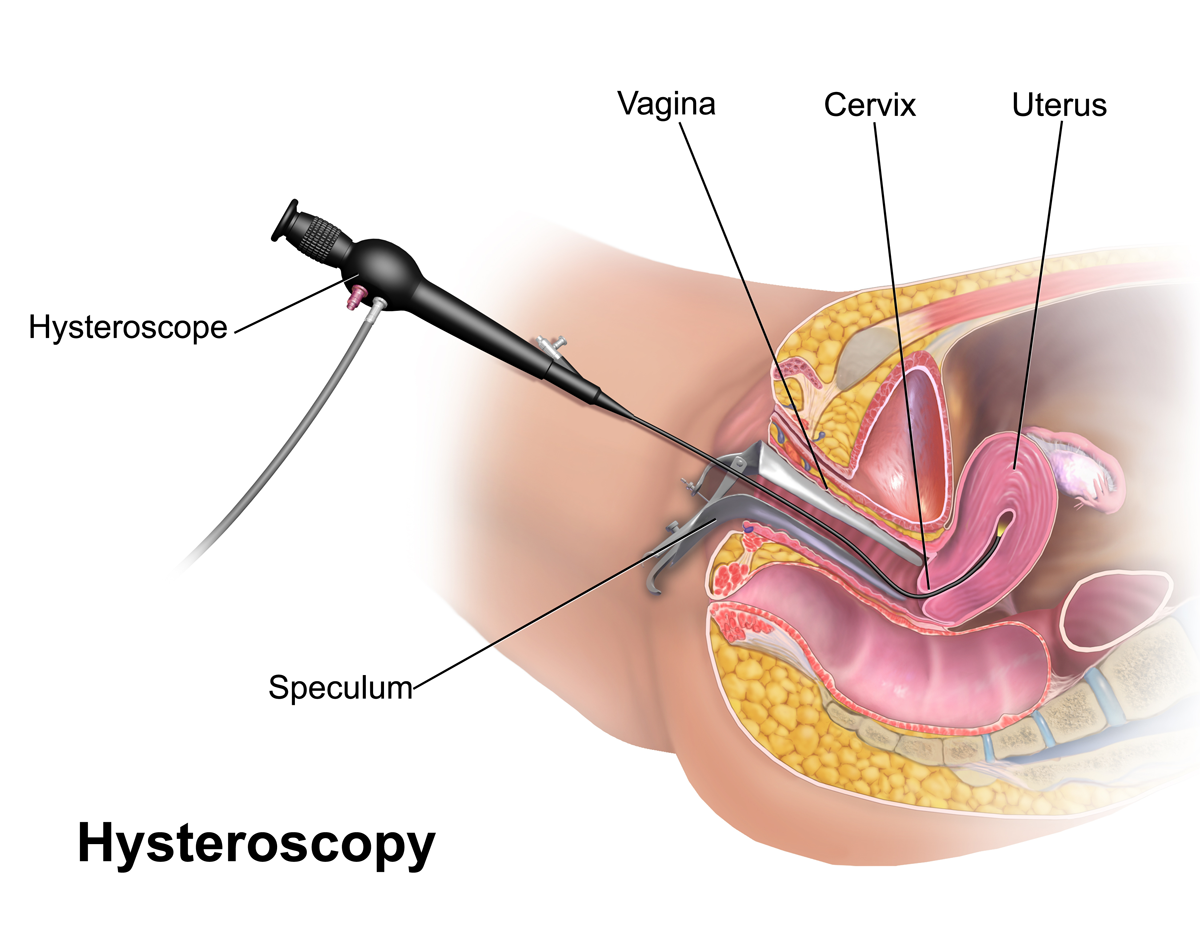 Diagnostic Hysteroscopy