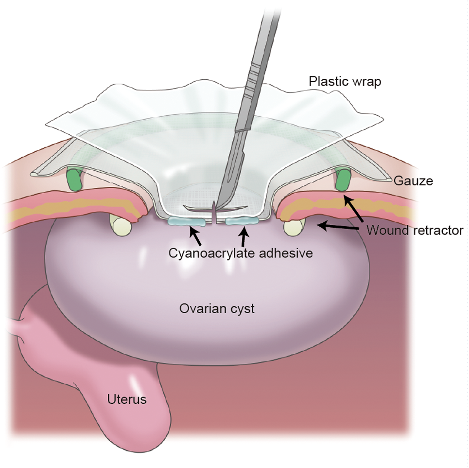 Cyst Aspiration