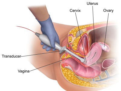 Trans Vaginal Sonography